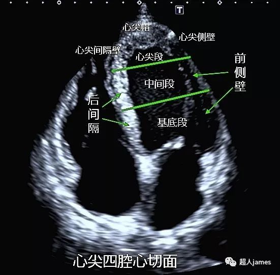 心尖四腔心切面:前侧壁基底段,前侧壁中间段,后间隔基底段,后间隔