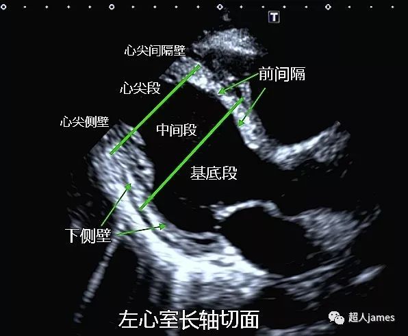 左心室分段图文全解