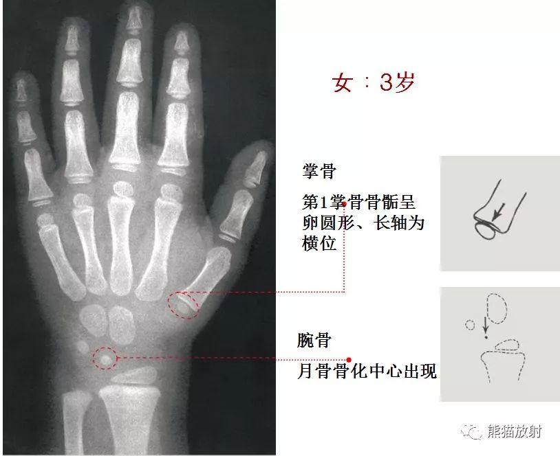 骨龄图谱(方便随时对照)