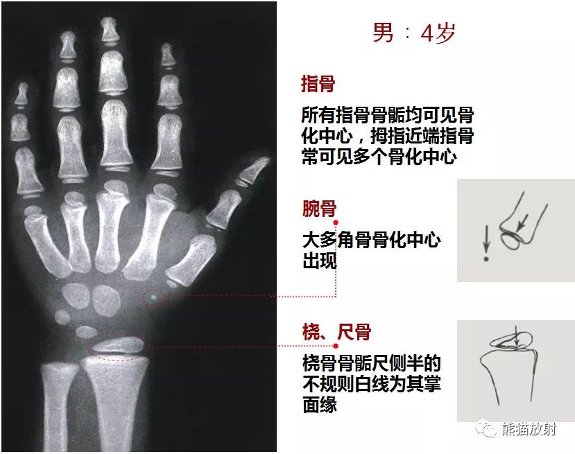 骨龄图谱!(方便随时对照)