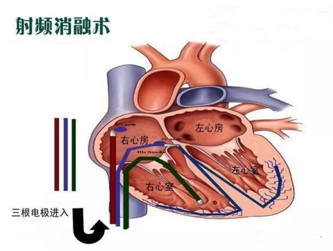 图(图片来源:网络)          心脏射频消融术(catheterradiofrequency