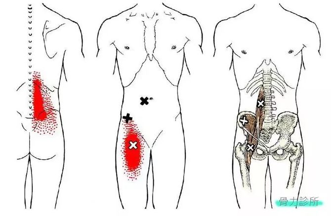"髂腰肌症候群"如何康复?