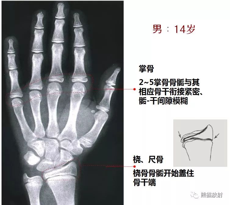 骨龄图谱!(方便随时对照)