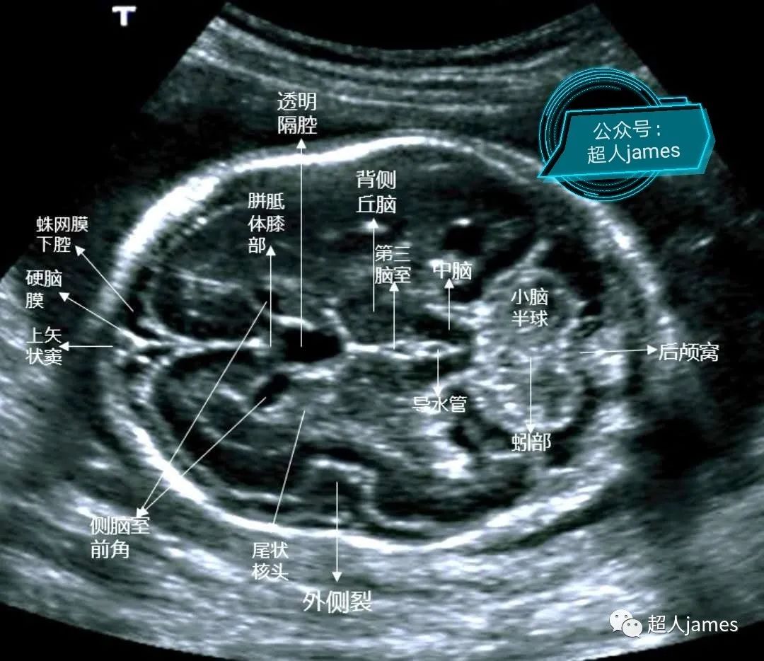 胎儿脑部超声切面图解图片
