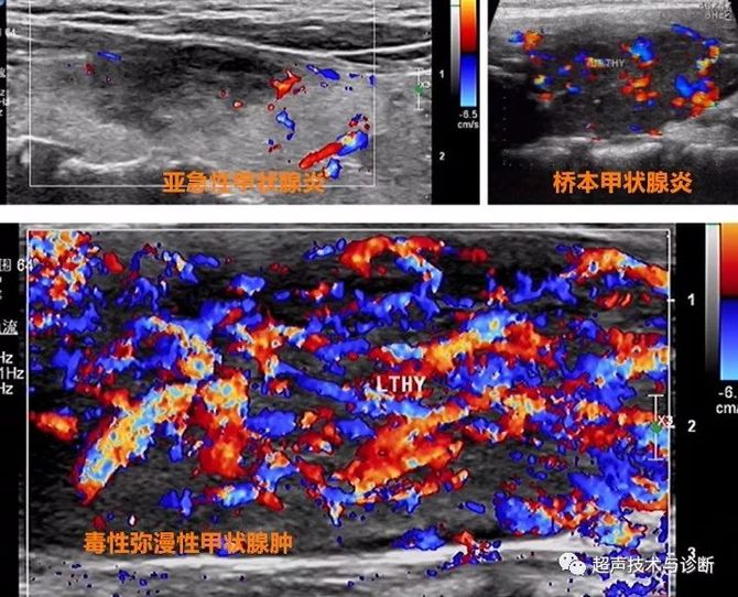 毒性瀰漫性甲狀腺腫內部血供豐富,呈