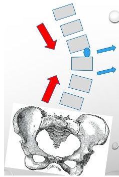 导致腰椎侧弯的重要原因 不平衡的腰大肌 康复知音 商业新知
