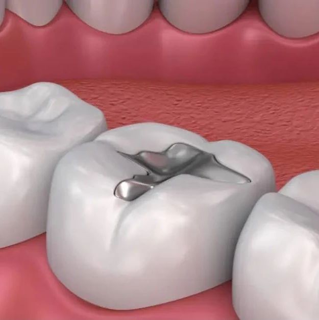 牙医锦囊:补牙性价比最高的美学材料