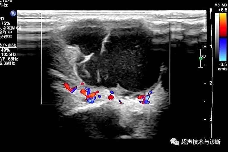 腮腺混合瘤彩超图片图片