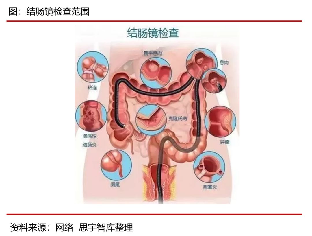 二,消化内科三大内镜之——结肠镜胶囊胃镜可由医生来精准操控胶囊