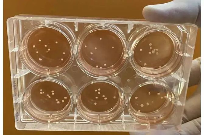 帕金森病又叫震颤麻痹,是由于脑内黑质纹状体通路多巴胺缺乏所致的,在