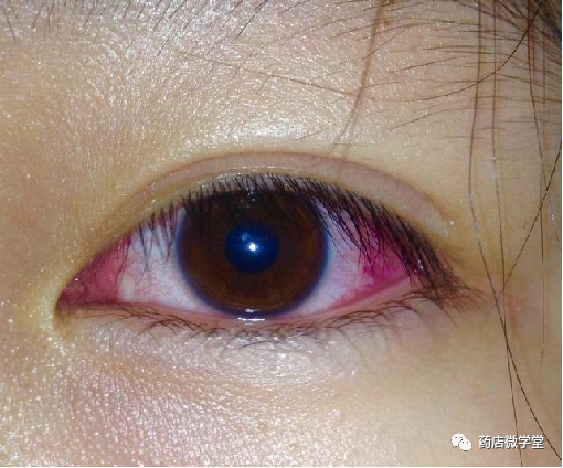 症状:因感染,过敏,外伤引起的眼结膜充血;表现为突发结膜充血,烧灼感