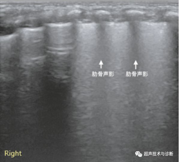 新知图谱, 肺部超声的基本征象