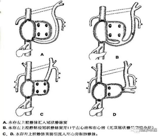 plsvc永存左上腔靜脈產前產後超聲診斷