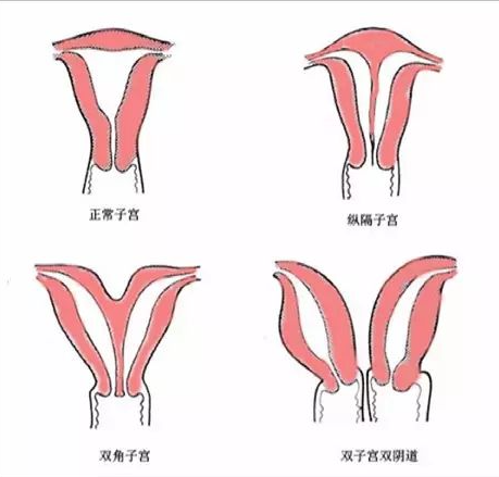 子宫套 有多大图片