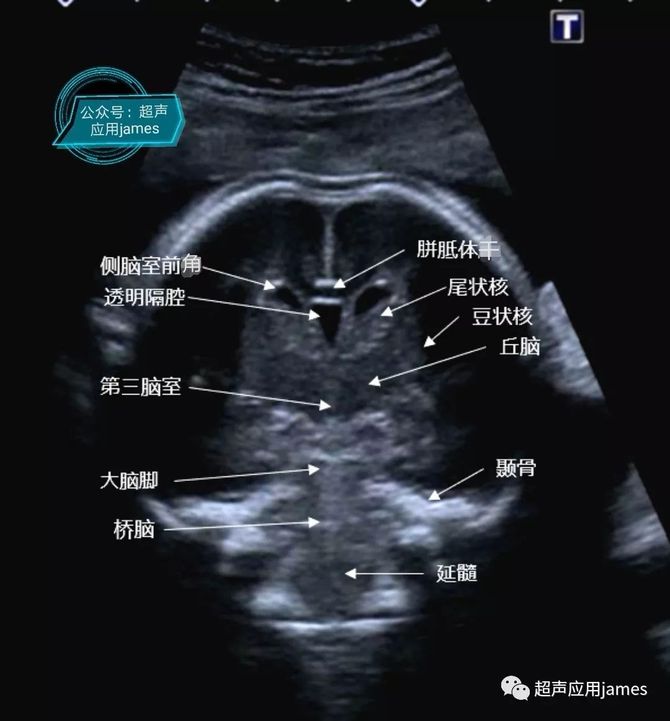 胎兒顱腦斜冠狀面超聲圖像解析