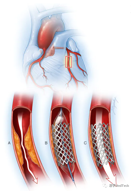 血管支架过程示意图图片