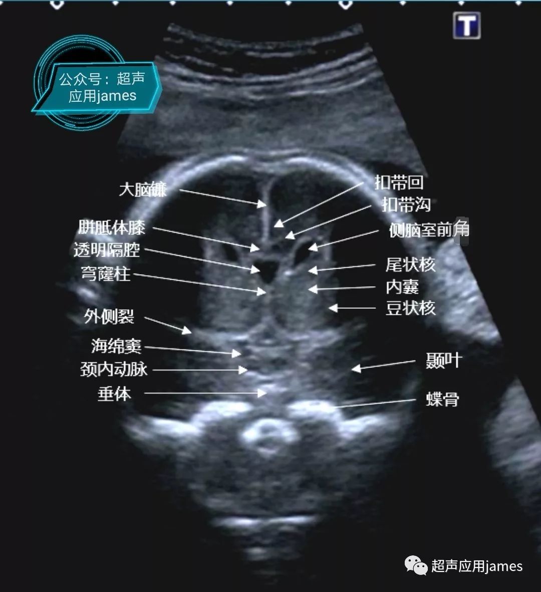 胎儿超声颅内结构图图片
