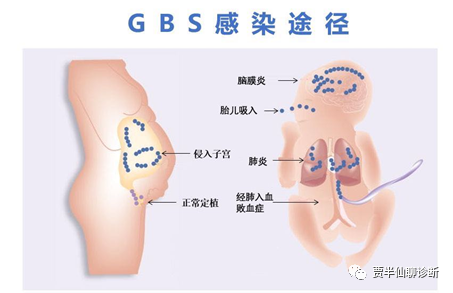医业观察, 一文读懂GBS（B族链球菌）检测及市场分析
