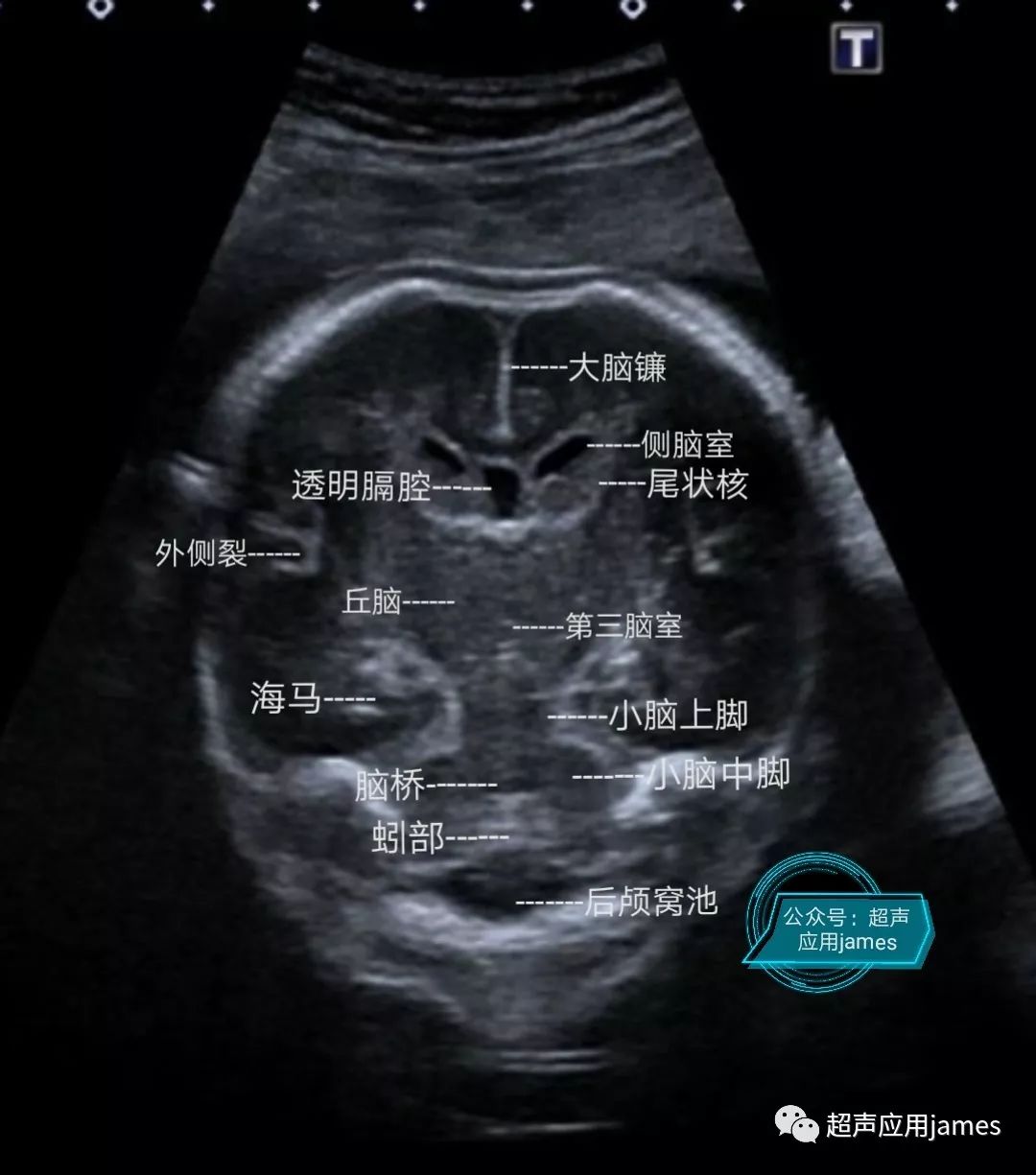 胎儿颅脑解剖示意图图片