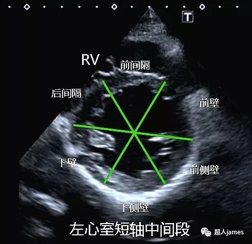 左心室分段图解图片