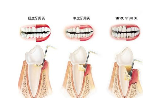 如果牙齦炎未能及時治療,炎症由牙齦向深層擴散到牙周膜,牙