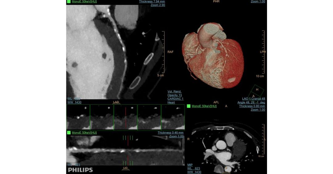 IQon Spectral CT图片