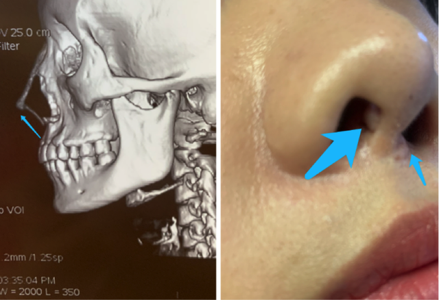 医生错误地为她置入了l形假体,术后鼻子有奇怪的增生,疤痕变多,假体