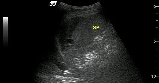 真性脾破裂超声图片图片