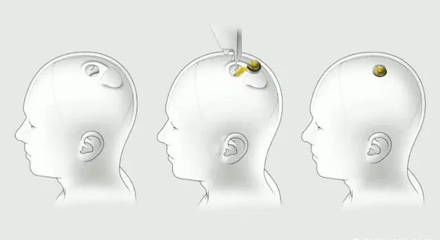 Synchron脑机接口图片