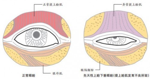 後天獲得性則是因為眼瞼本身病變引起,神經系統及其他全身性病變導致.