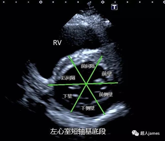 左心室分段图文全解