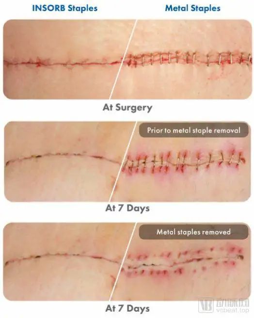 获94受访者青睐成立22年售出数百万台吻合器的incisivesurgical是怎样