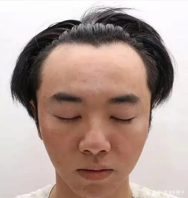 狂人谈植发(狂人植发效果)