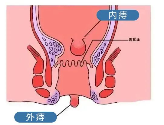 24元就能把折磨千万人的痔疮拔起,不痛不痒真舒服!
